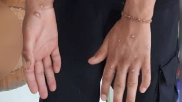 Yunanistan'da ilk maymun çiçeği vakası tespit edildi